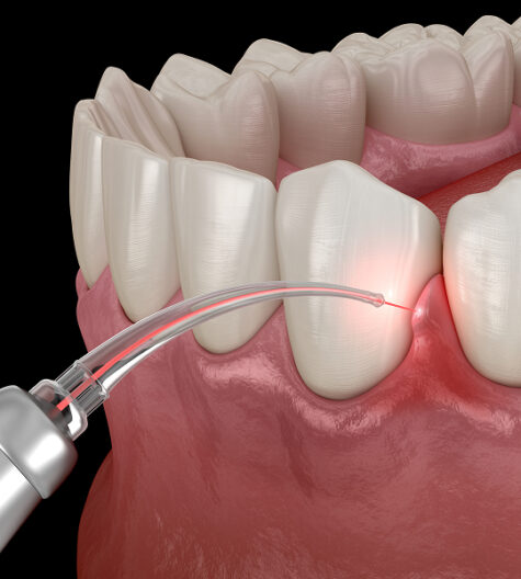 Lasersko zobozdravstvo